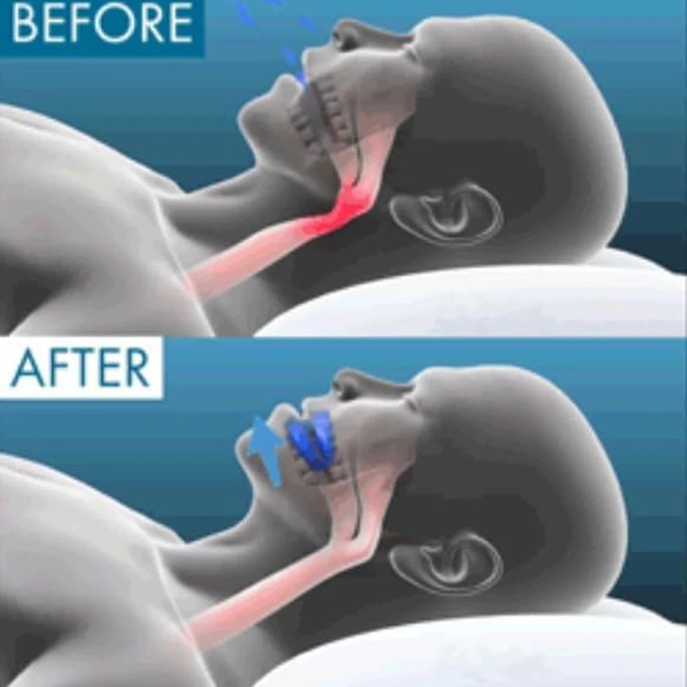 Effective Anti Snoring Mouthpiece Sleep Aid For Quiet Night Rest